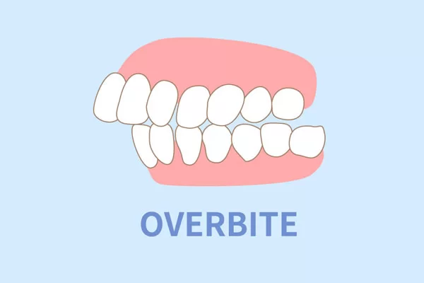 overbite illustration