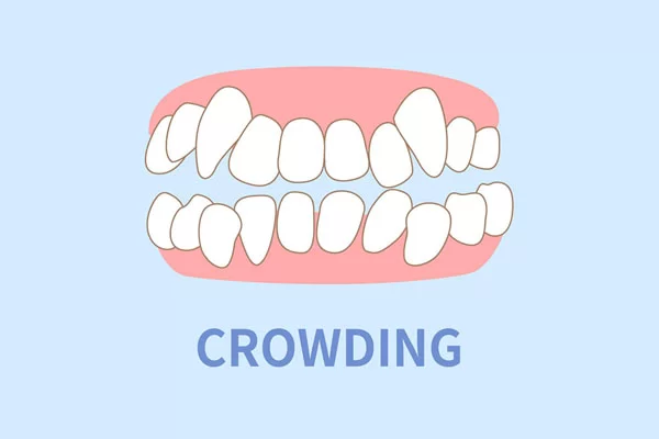 tooth crowding