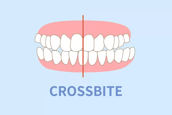 crossbite illustration