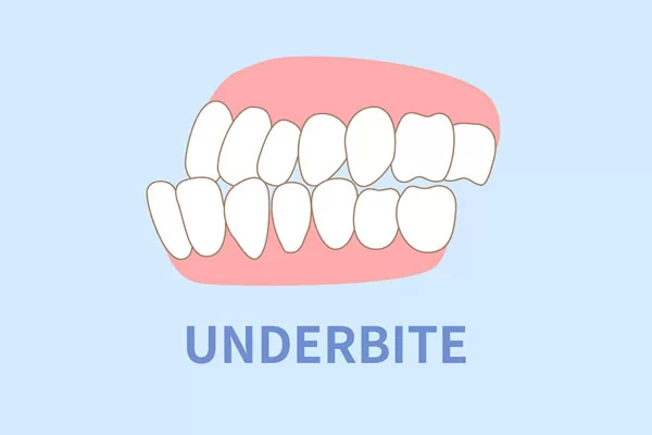 underbite illustration