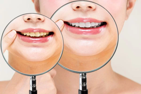 teeth stains; before and after teeth whitening treatment