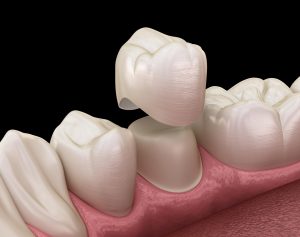 dental crowns